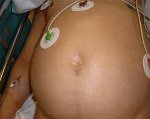 Кровотечение в брюшную полость Кровотечение в брюшную полость