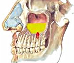 Одонтогенный гайморит