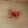 Реконструкция колостомы
