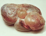 Андробластома яичника Андробластома яичника