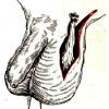 Орхифуникулэктомия