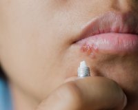 Что такое лабиальный герпес лабиальный. Смотреть фото Что такое лабиальный герпес лабиальный. Смотреть картинку Что такое лабиальный герпес лабиальный. Картинка про Что такое лабиальный герпес лабиальный. Фото Что такое лабиальный герпес лабиальный