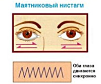 Нистагм