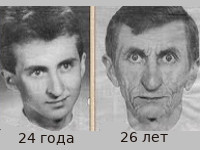 Синдром хатчинсона гилфорда детская прогерия thumbnail