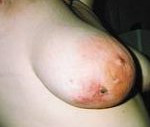 Актиномикоз молочных желез