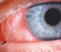 Дирофиляриоз глаз