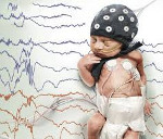 Неонатальные судороги Неонатальные судороги