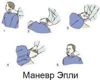 Пароксизмальное позиционное головокружение