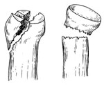 Перелом головки лучевой кости локтевого сустава: симптомы, лечение и восстановление локтя со смещением и без
