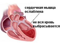 Сердечная недостаточность