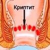 Криптэктомия (иссечение анальной крипты)