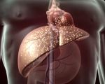 Фиброз печени Фиброз печени