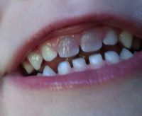 Тетрациклиновые зубы 