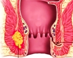 Парапроктит у детей