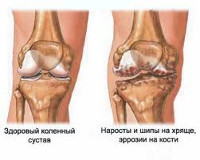 Гонартроз коленного сустава это