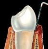 Склерозирующая терапия в области зуба