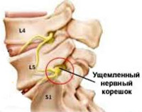 Грыжа спинного мозга у новорожденных симптомы диагностика и лечение