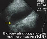 Признаки сладжа в желчном пузыре что это
