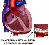 Аритмогенная правожелудочковая кардиомиопатия