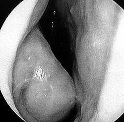 Отек и гипертрофия нижней носовой раковины при аллергическом рините. Эндоскопическое фото