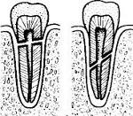 Перелом корня зуба 