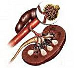 Дисметаболическая нефропатия у детей