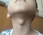 Срединная киста шеи у детей
