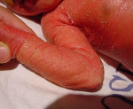 Врожденная ихтиозиформная эритродермия Брока