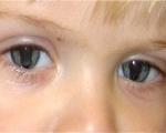 Синдром кошачьего глаза