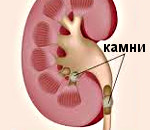Мочекаменная болезнь у детей