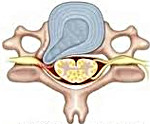 Протрузия межпозвоночного диска