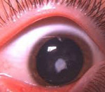 Врожденная катаракта