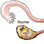 Фолликулярная киста яичника Фолликулярная киста яичника