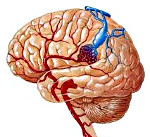 Артериовенозные мальформации головного мозга