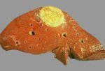 Киста печени Киста печени